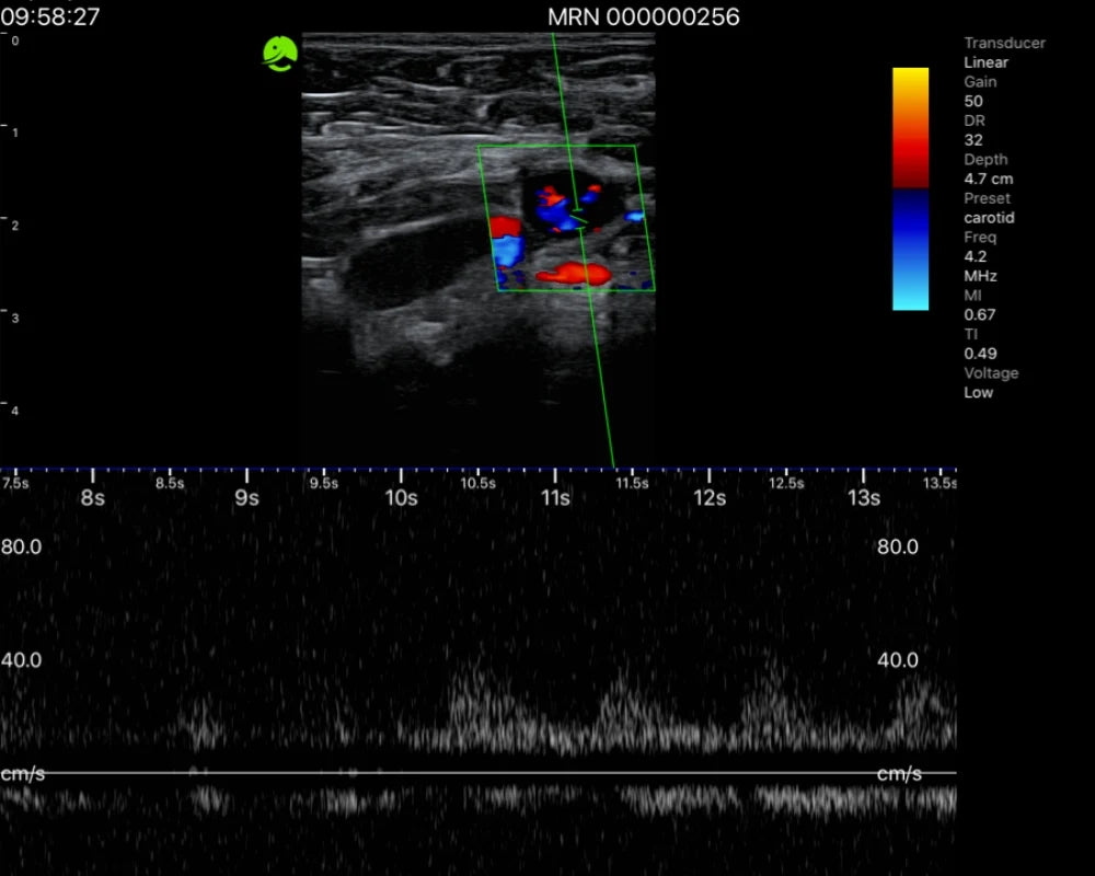 Breast — ultrasound image 3