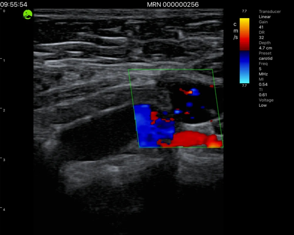 Breast — ultrasound image 2