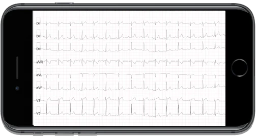 ECG is the abbreviation for electrocardiogram, a test that tracks the electrical activity of the heart and records it on moving paper or as a moving line on a screen. The ECG tracing is the simplest, most widespread, and cost-effective method for analyzing the heart and detecting irregularities that could lead to serious health problems, such as stroke or heart attack. By analyzing an ECG, a doctor can obtain crucial information about the health and activity of the heart muscle, much more than can be inferred from heart rate alone, which is the parameter monitored by most wearable devices.
