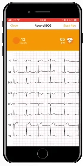 D-Heart e app per la registrazione ECG