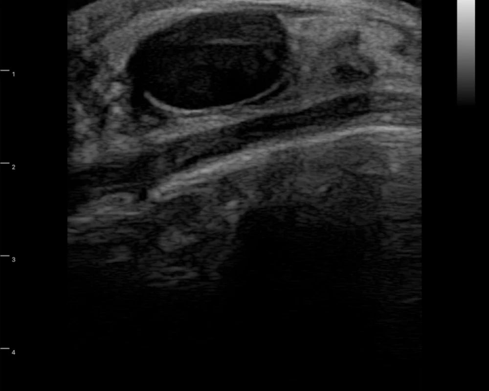 Breast — ultrasound image 1